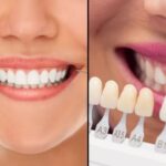 Veneers vs. Tooth Whitening