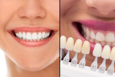 Tooth Whitening vs. Veneers – Which Should I Get?