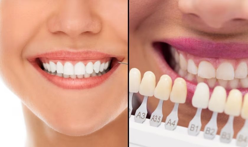 Veneers vs. Tooth Whitening