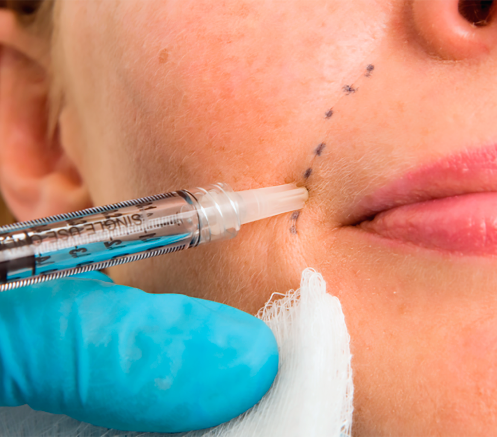 Advanced Aesthetic Lip Fillers