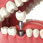 Are Dental Implants Worth the Long-Term Benefits