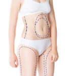 Can Laser Liposuction Enhance Body Confidence