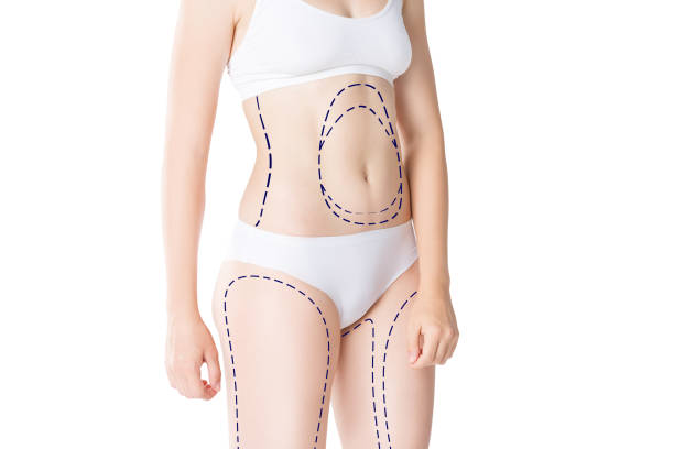 Can Laser Liposuction Enhance Body Confidence