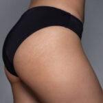 Does Buttock Lift Surgery Tighten the Skin?