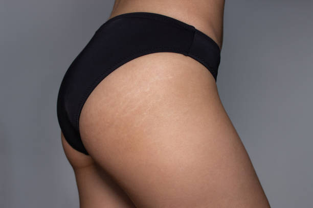 Does Buttock Lift Surgery Tighten the Skin?