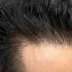 Shine Hair Brightly Today with Hair Transplant Cost Advice