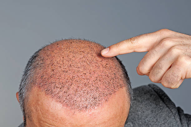 How Hair Transplant Boosts Volume Naturally