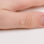 How Long Does Warts Removal Treatment Take?