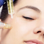 How Mesotherapy Helps with Acne Scarring