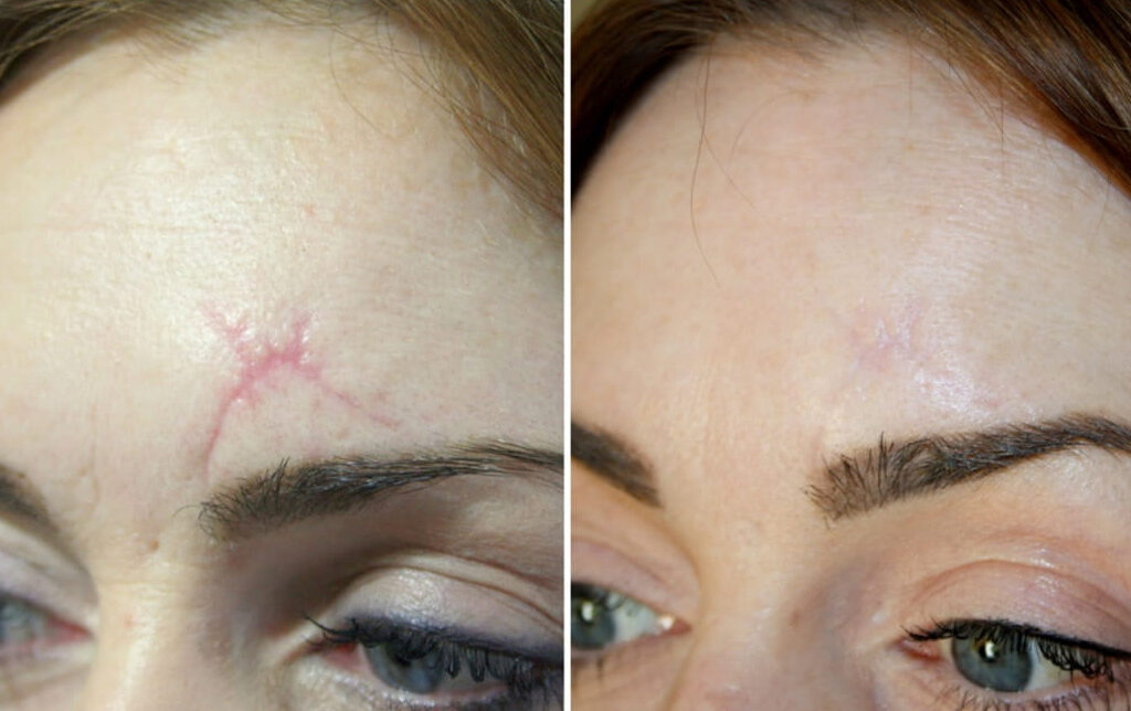 Inkless Stretch Mark Removal