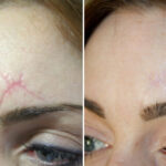 Inkless Stretch Mark Removal