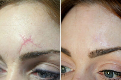 How Inkless Stretch Mark Treatments Boost Collagen Naturally