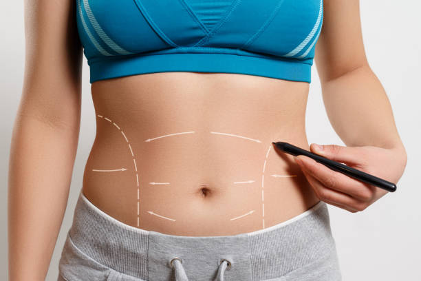 Is Tummy Tuck a Permanent Solution