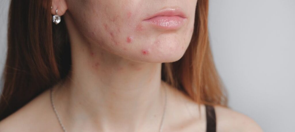 Non-Surgical Acne Treatment