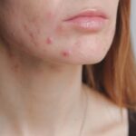 Non-Surgical Acne Treatment