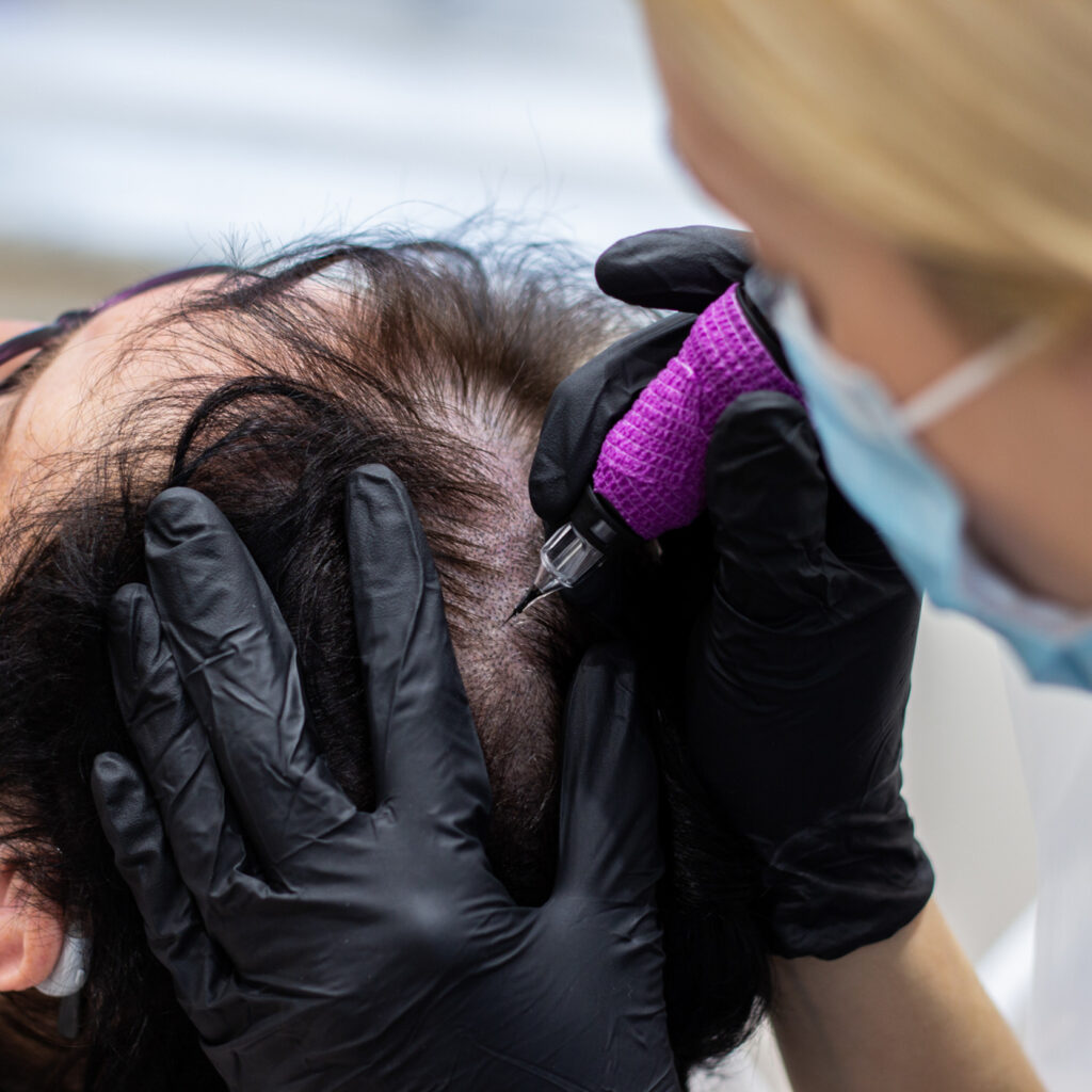 Non-Surgical Hair Restoration with Scalp Micropigmentation