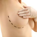 Refined and Natural Breast Augmentation