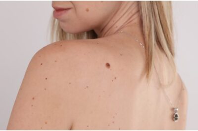 Skin Tag Removal Price | Complete Guide to Costs, Methods & What to Expect