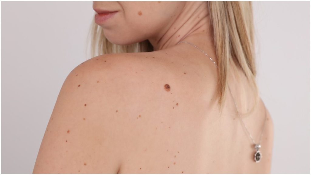 Skin Tag Removal Price