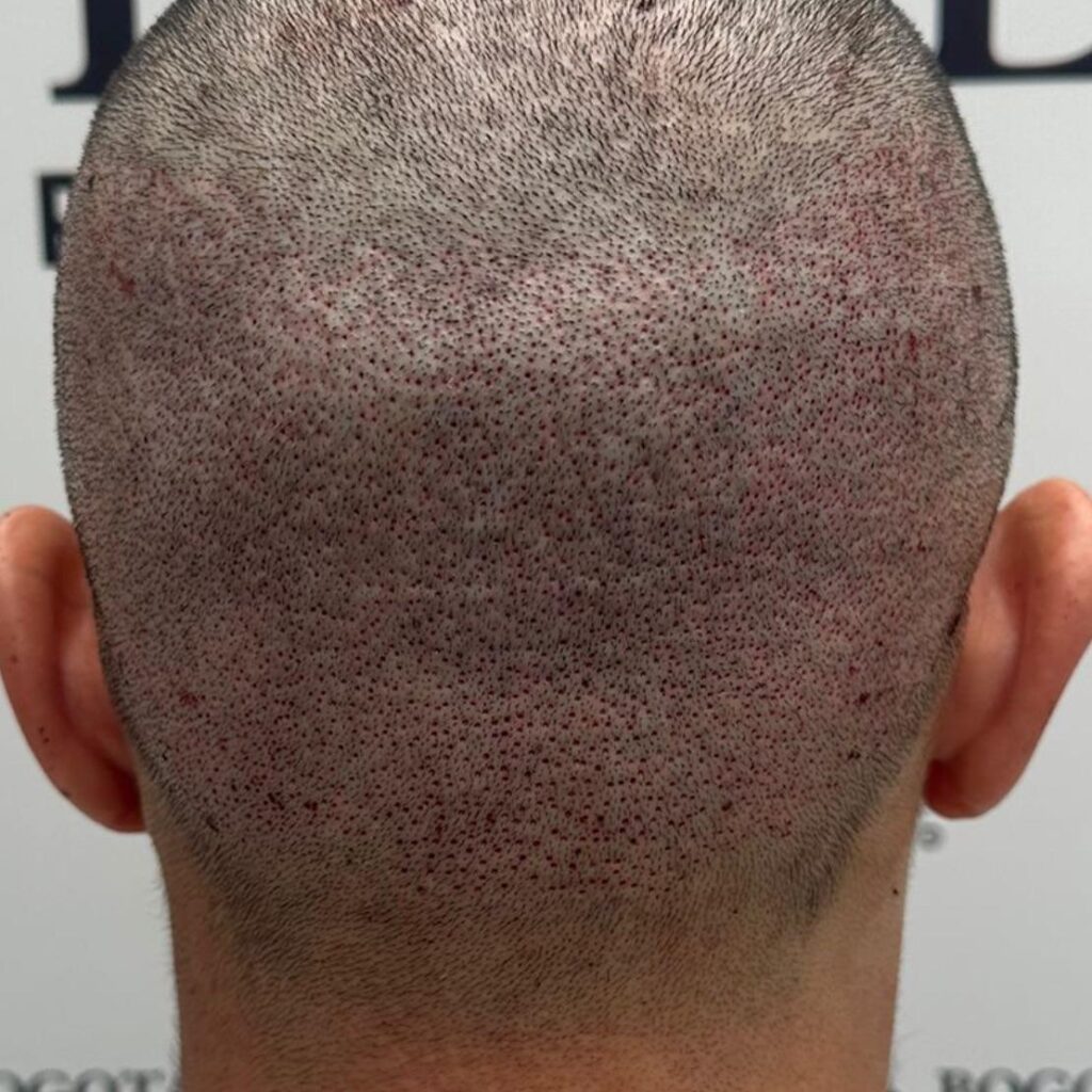 Step into a New You with Hair Transplant