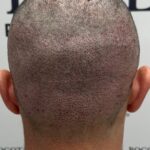 Step into a New You with Hair Transplant