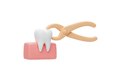 5 Times When Tooth Extraction Becomes Necessary!