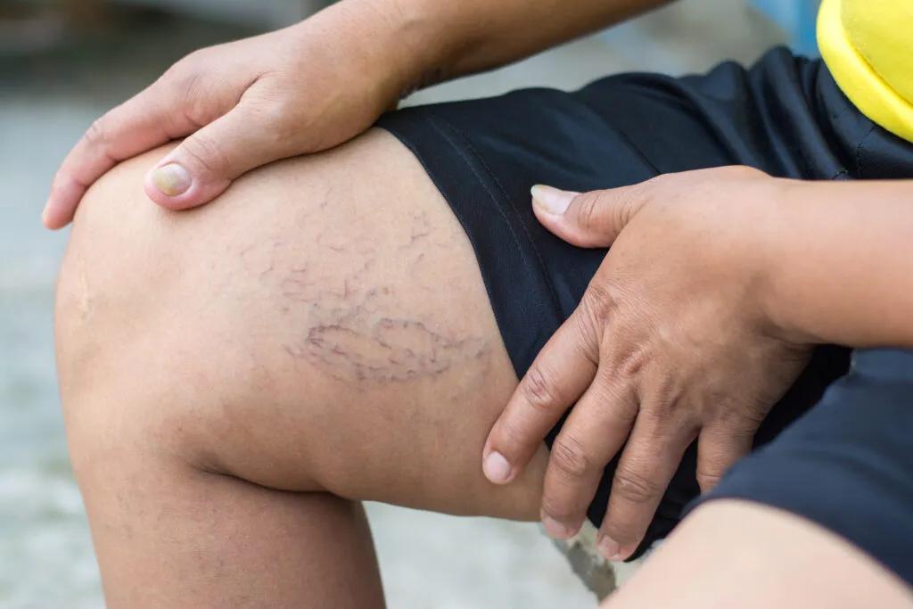 What Makes Sclerotherapy a Trusted Vein Fix