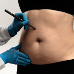 What is Liposuction and How Does it Work?