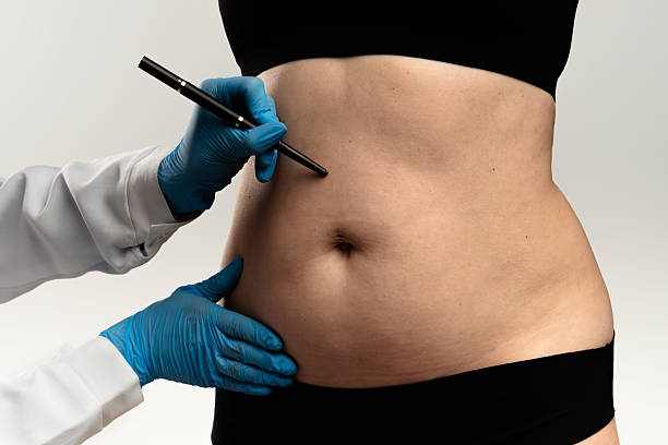 What is Liposuction and How Does it Work?