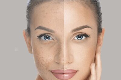 Transform Your Skin with Advanced Skin Whitening Treatment in Islamabad