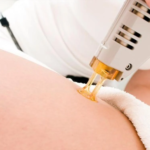 Advanced Laser Vaginal Rejuvenation Technology