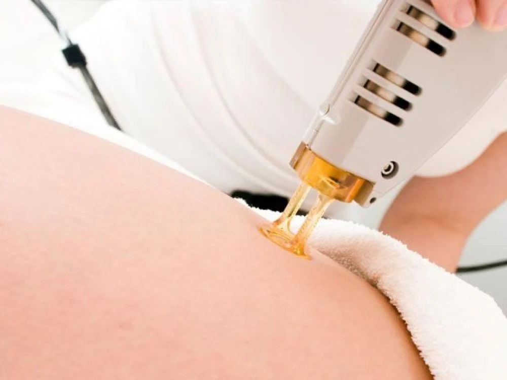 Advanced Laser Vaginal Rejuvenation Technology