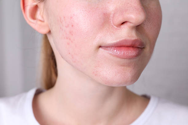 Can Acne Treatment Prevent Future Acne Flare-Ups