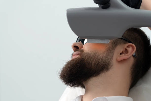 Can Beard Laser Hair Removal Help Patchy Beards