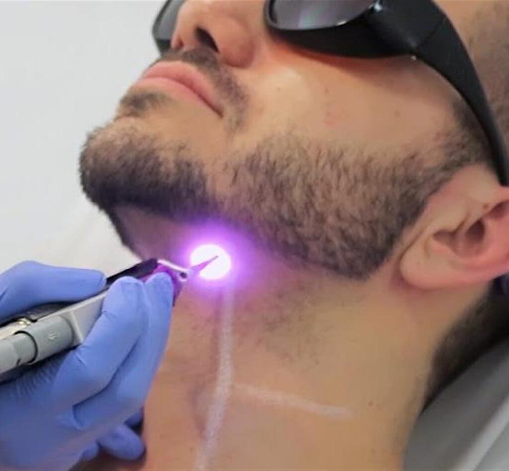 Can Beard Laser Hair Removal Prevent Ingrown Hairs