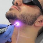 Can Beard Laser Hair Removal Prevent Ingrown Hairs
