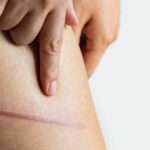 Can Dark Scars Fade with Post Surgical Scars Treatment