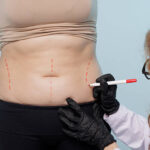 Can Liposuction Enhance Natural Body Curves