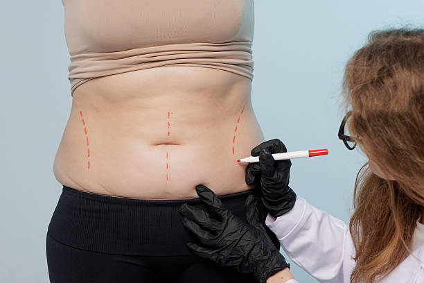 Can Liposuction Enhance Natural Body Curves