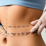 Customized Tummy Tuck Treatments for Every Body Type