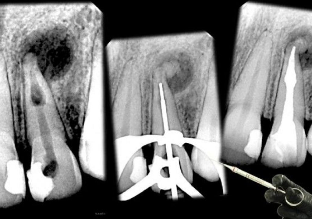 Dental Internal Resorption