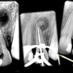 Dental Internal Resorption