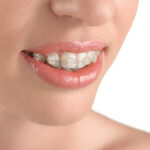Do Ceramic Braces Stain During Long Treatments