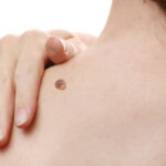 Does Warts Removal Leave Scars Behind