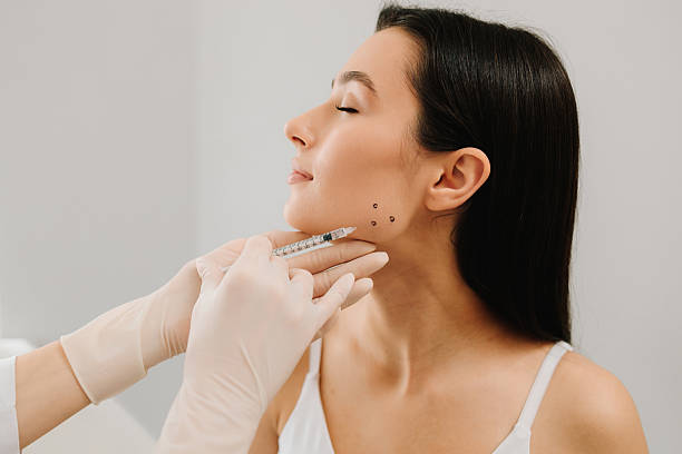 Does masseter botox create a V-shaped face