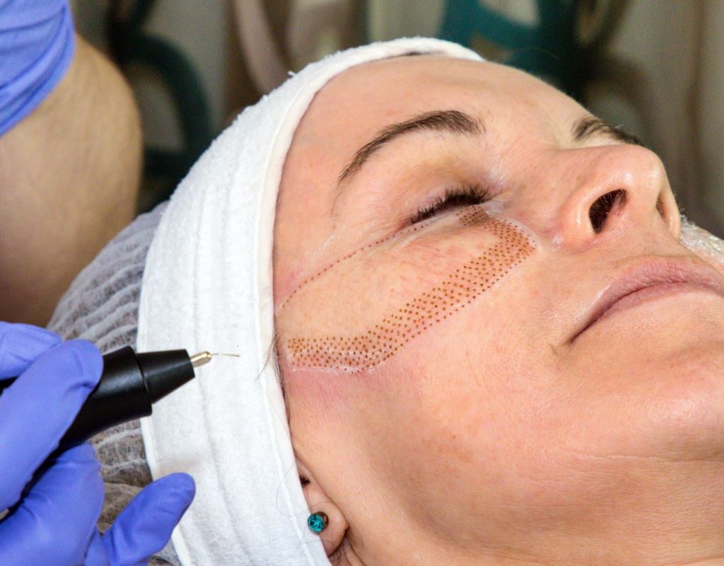 Dose Plasma Pen Treatment Stimulate Collagen