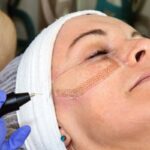 Dose Plasma Pen Treatment Stimulate Collagen