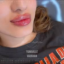 Everything You Need to Know About Russian Lip Fillers