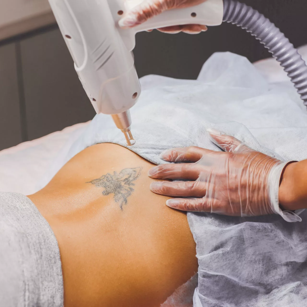 How Does Laser Tattoo Removal Work for Old Tattoos