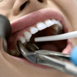 How Does Tooth Removal Treat Severe Gum Disease